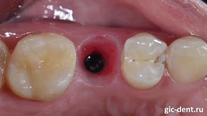 Как лучше вставлять зубы: методики восстановления