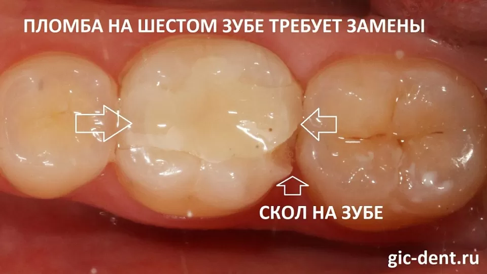 Цельнокерамические вкладки для 6 нижнего зуба - Немецкий имплантологический центр. Восстанавливаем шестой зуб