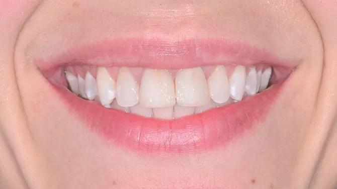 Цельнокерамические коронки виниры на два центральных верхних зуба