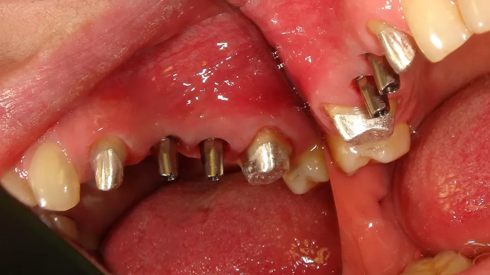 Протезирование на имплантах зубов 4 и 5 верхней челюсти