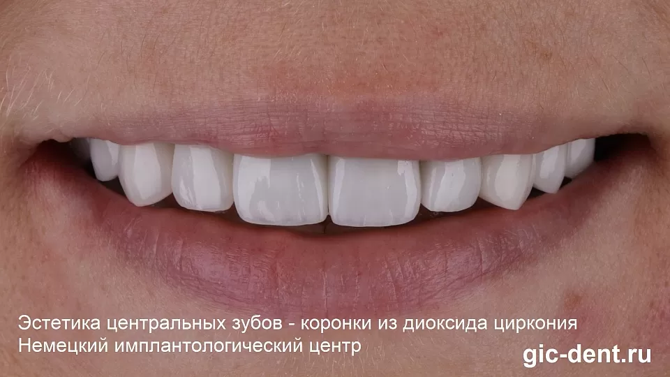Три коронки из диоксида циркония решили проблему эстетики передних зубов