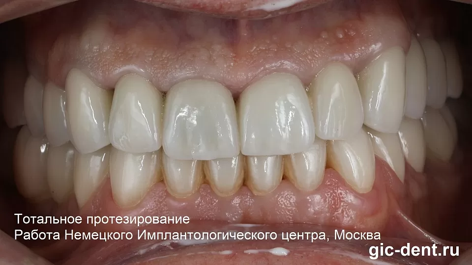 Почему зубные мосты нужно менять на одиночные коронки