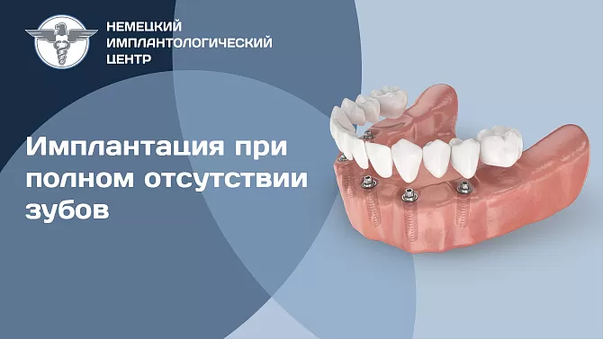 Имплантация при полном отсутствии зубов