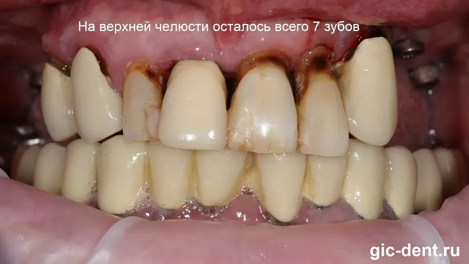 Сложное протезирование зубов верхней челюсти и в 70 лет дает прекрасный результат!