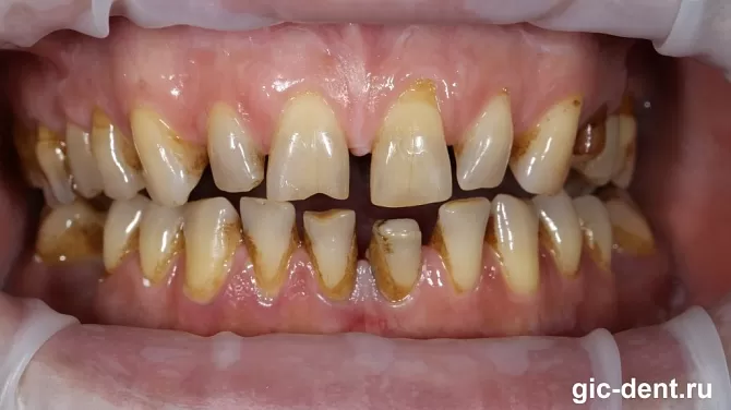 Пример как можно поставить виниры, если нет нескольких зубов