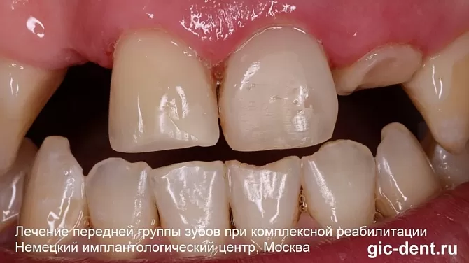 Пример лечения кариеса передних зубов при последующей имплантации и протезировании
